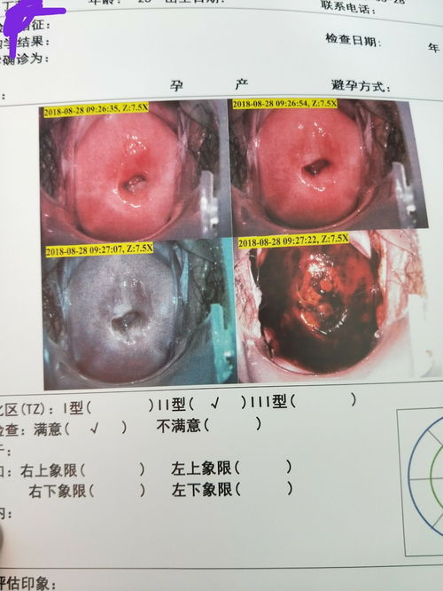 怀孕后宫颈息肉出血怎么办呢