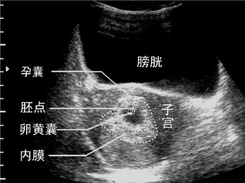 怀孕7周未见卵黄囊，胎儿正常吗？