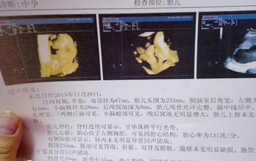 怀孕多久可以做b超检查出来