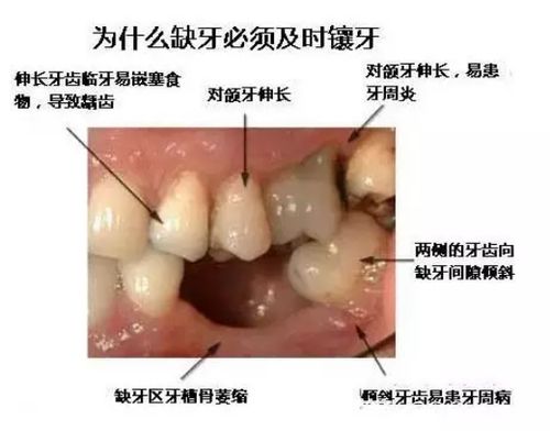 种植一颗牙多少钱？