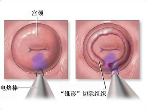 卵巢囊肿需要治疗吗?严重吗