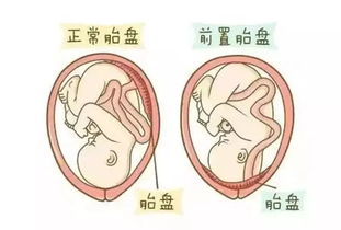 什么是前置胎盘的典型症状