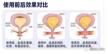 盆底肌肉的康复训练，怎么做的..