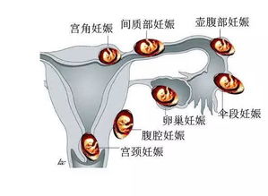 宫外孕的几个外部征兆图片