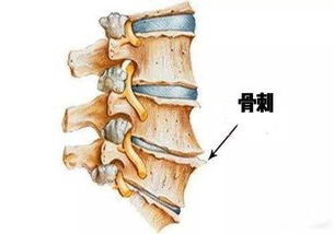 骨刺的治疗方法