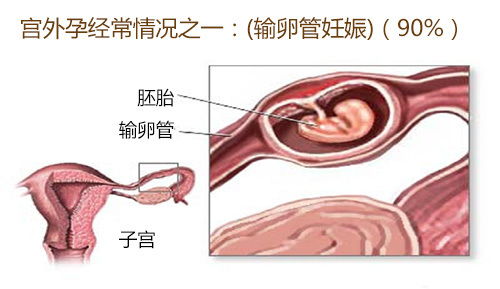 宫外孕有哪些症状表现