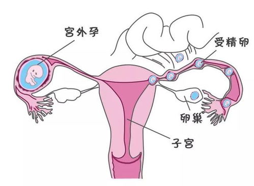 宫外孕有哪些症状表现