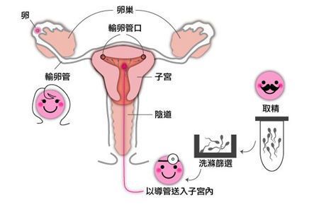 不明原因不孕不育能做人工授精吗