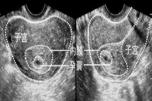 怀孕40天可以做b超吗?能看到孕囊吗?