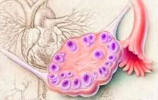 体重很瘦会是多囊卵巢综合征吗