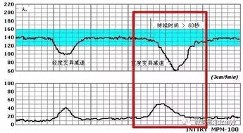 妇产科胎心监护图怎么看？