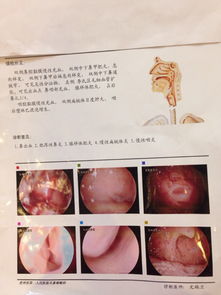 tct和hpv检查后出血几天正常吗