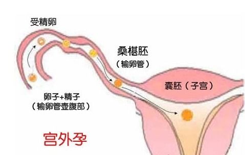 宫外孕保守治疗