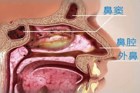 提问：鼻窦炎手术后怎么还那么多鼻涕