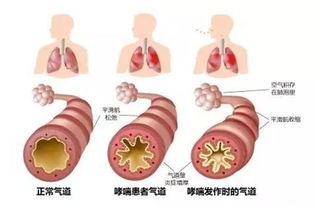 饮食如何调养急性支气管炎哮喘