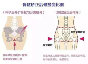 宝妈们生完有做盆底康复的吗