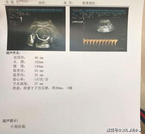 哪种孕囊属于茄子型图片