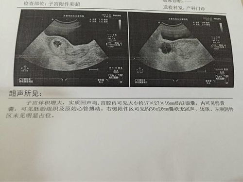 做B超看不到孕囊，怎么回事？