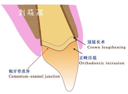 智齿拔出后牙槽骨会消失吗?