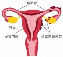 子宫外孕对女性有什么影响吗