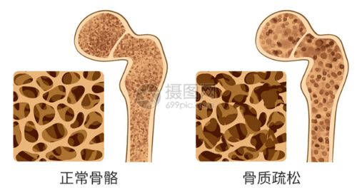 23周 骨质疏松 怎么补钙比较好