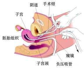 打胎的危害有哪些