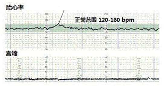 我的胎监评分总是6-8分正常么