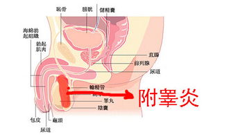 急性附睾炎硬结怎么能消除