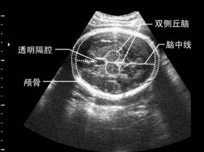 胎儿左心室有4mm强回声..强光斑严重吗?