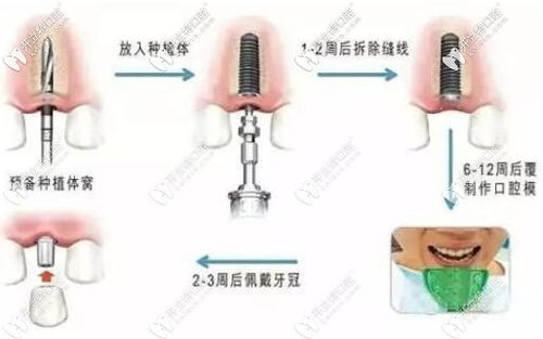 种一颗牙最低多少钱