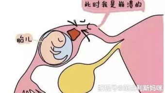 女性宫外孕会来月经吗会怀孕吗