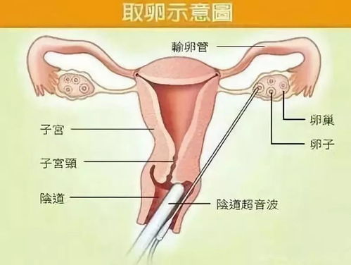 取卵后卵巢扭转的症状