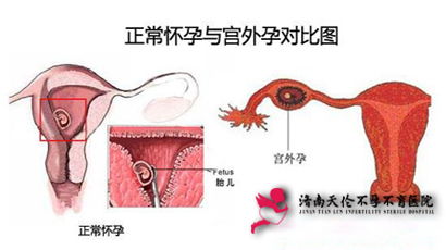 造成宫外孕的原因有哪些