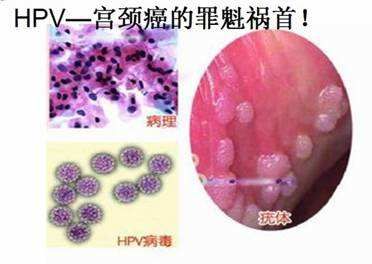 hpv阳性用保妇康栓能治好吗