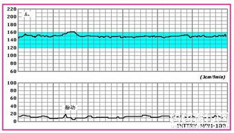 胎心监护图线是平的没有什么波浪