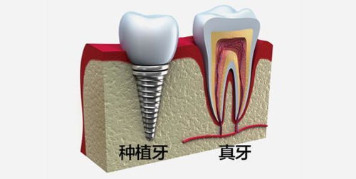 种植牙多少钱一颗？