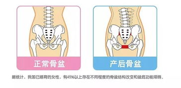 耻骨分离的症状图片