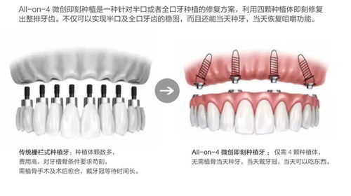 广州种植牙去哪家牙科？