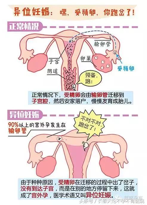 哪些情况会影响宫外孕