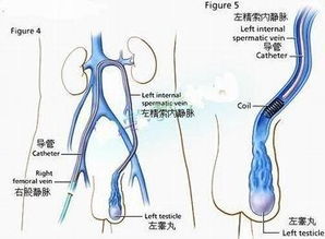 中度精索静脉曲张是什么意思