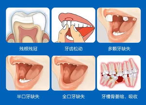 做牙瓷贴面可以报医疗保险吗？