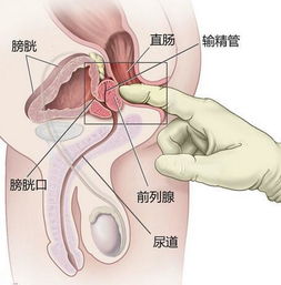 前列腺炎如何保健效果最好