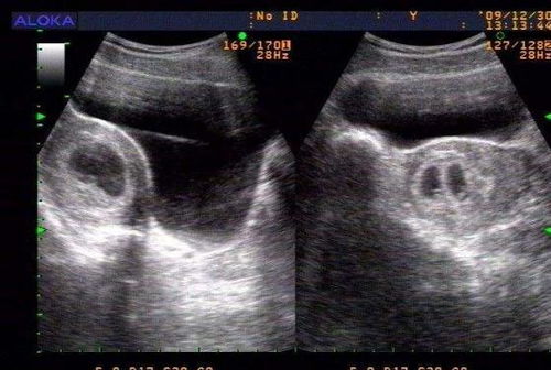 怀孕九周，查出两个孕囊，，，，是龙凤胎吗