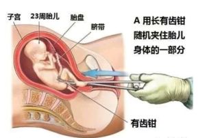 空孕囊会自己流掉吗没有流血