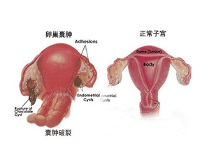 卵巢囊肿一定要做手术吗 知乎