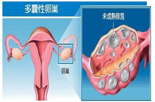 关于多囊卵巢综合征你真的了解吗