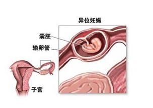 输卵管堵塞还可以排卵吗?