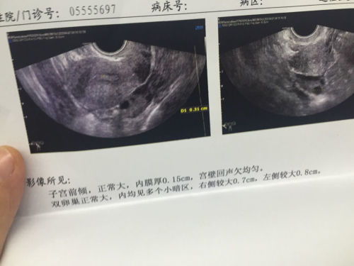 内膜异位症b超能看到吗多少钱