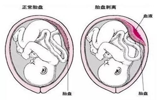 分娩前如何预防胎盘早剥症状