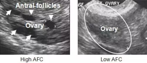 两边卵巢一共7个窦卵泡正常吗